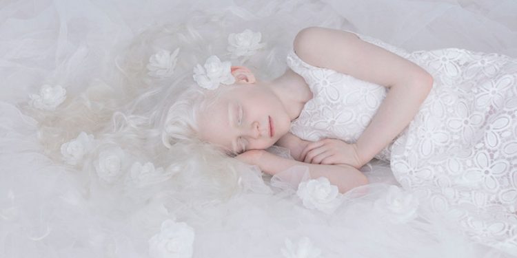 Mundo Albino mundo blanco