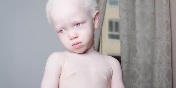 Mundo Albino mundo blanco