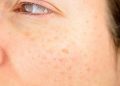 Seis tipos de manchas en la piel: ¿qué significan y cómo tratarlas?