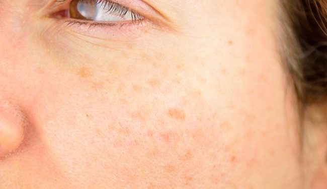 Seis tipos de manchas en la piel: ¿qué significan y cómo tratarlas?
