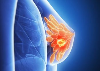 Cáncer de mama: ¿qué sigue después del diagnóstico?