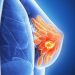 Cáncer de mama: ¿qué sigue después del diagnóstico?