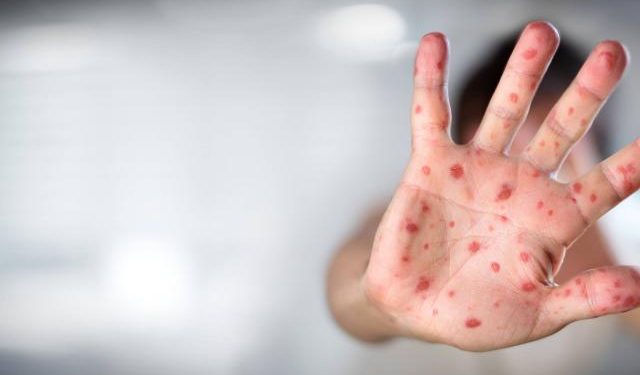 La viruela del mono y sus formas de contagio