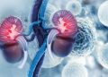 El cáncer de riñón; más común de lo que se piensa