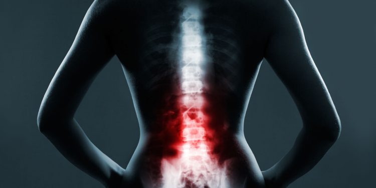 Mieloma múltiple y principales síntomas