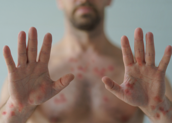 Viruela símica, hay más casos de los que creemos