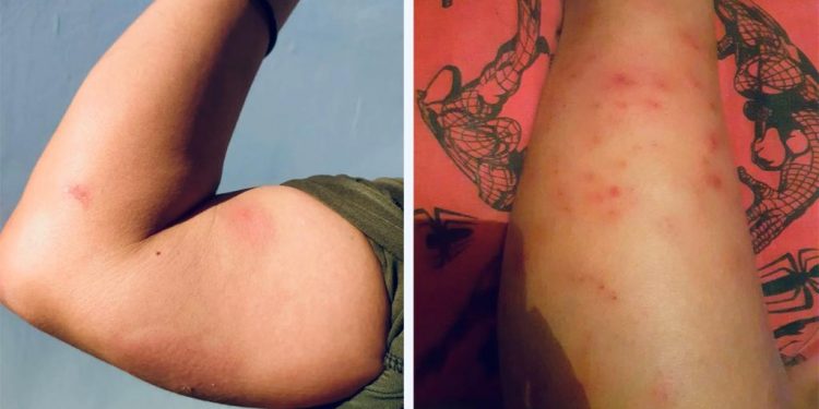 Urge fumigación en Molino de Camou por picaduras de insecto