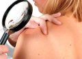 Con estas 5 señales se puede detectar a tiempo el cáncer de piel