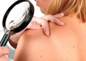 Con estas 5 señales se puede detectar a tiempo el cáncer de piel