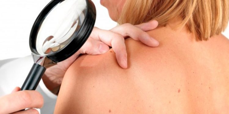 Con estas 5 señales se puede detectar a tiempo el cáncer de piel