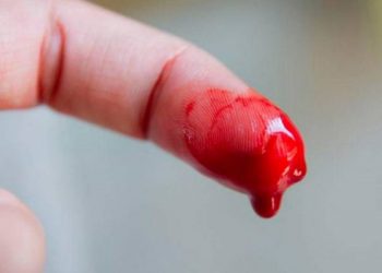 Por esta razón la Hemofilia se le conoce como la enfermedad de los Reyes