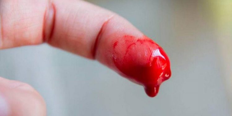 Por esta razón la Hemofilia se le conoce como la enfermedad de los Reyes