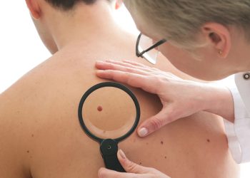 Hasta al lunar que heredamos de la abuela debemos ponerle atención