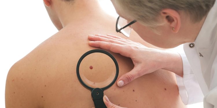 Hasta al lunar que heredamos de la abuela debemos ponerle atención