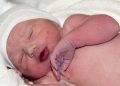 Bebés que nacen morado o se ponen morados