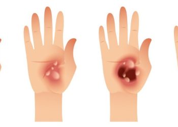 En qué consiste la categoría de las quemadoras