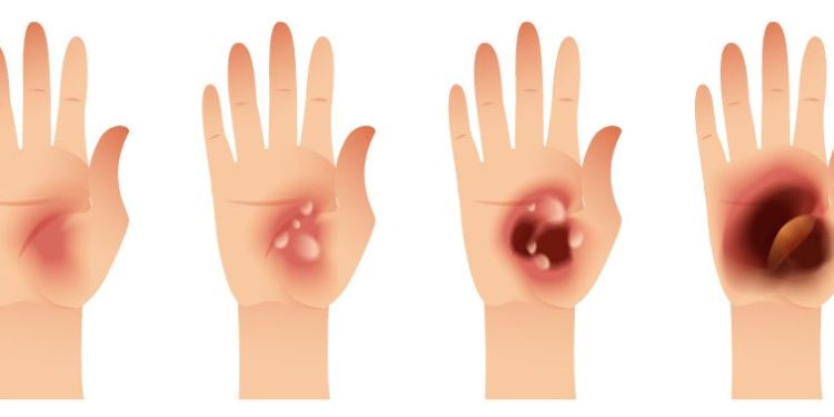 En qué consiste la categoría de las quemadoras