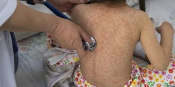 Sonora frente al regreso del sarampión