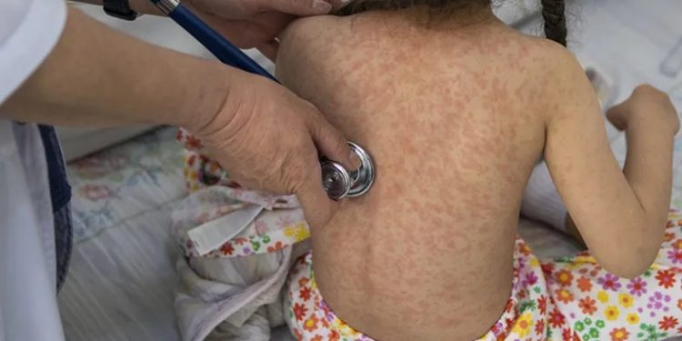 Sonora frente al regreso del sarampión